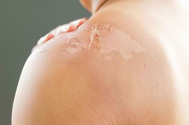 Efek sunburn yang dapat merusak kulit